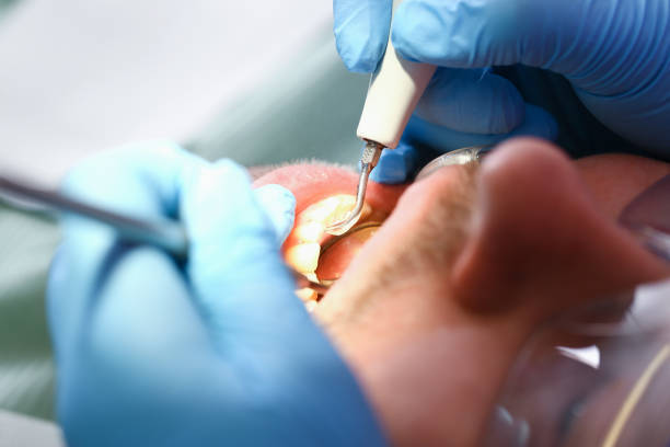 Best Emergency Tooth Extraction in Berkeley, MO